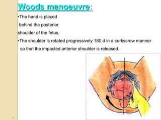 .
Woods manoeuvre:
•The hand is placed
behind the posterior
shoulder of the fetus.
•The shoulder is rotated progressively 180 d in a corkscrew manner
so that the impacted anterior shoulder is released.
 