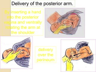 By inserting a hand
into the posterior
vagina and ventrally
rotating the arm at
the shoulder
delivery
over the
perineum
Delivery of the posterior arm.
 