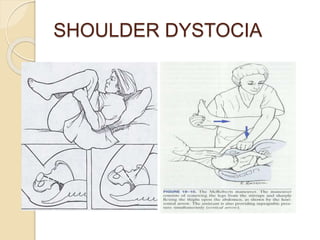 SHOULDER DYSTOCIA
 