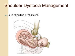 Shoulder Dystocia Management
 Suprapubic Pressure
 