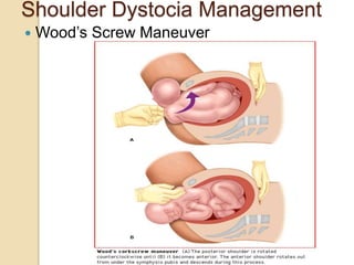 Shoulder Dystocia Management
 Wood’s Screw Maneuver
 