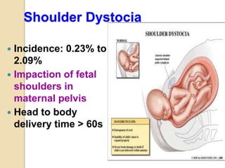 Shoulder Dystocia
 Incidence: 0.23% to
2.09%
 Impaction of fetal
shoulders in
maternal pelvis
 Head to body
delivery time > 60s
 