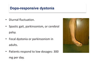 Dystonia | PDF