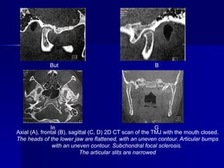 Comprehensive Overview of Temporomandibular Joint Osteoarthritis ...