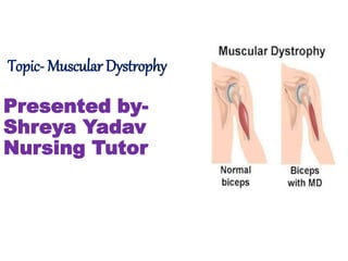 Topic- Muscular Dystrophy
Presented by-
Shreya Yadav
Nursing Tutor
 