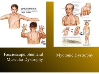 Dystrophy ppt