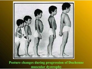 Dystrophy ppt