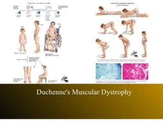 Dystrophy ppt