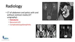 Radiology
• CT of abdomen and pelvis with and
without contrast media (CT
urography):
• Hematuria
• Recurrent UTI
• Complicated pyelonephritis
 
