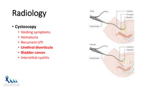 Radiology
• Cystoscopy
• Voiding symptoms
• Hematuria
• Recurrent UTI
• Urethral diverticula
• Bladder cancer
• Interstitial cystitis
 