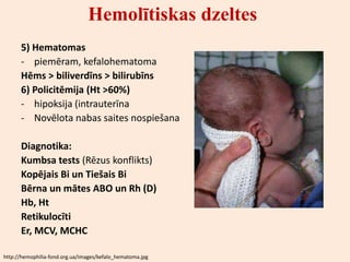 Hemolītiskas dzeltes
      5) Hematomas
      - piemēram, kefalohematoma
      Hēms > biliverdīns > bilirubīns
      6) Policitēmija (Ht >60%)
      - hipoksija (intrauterīna
      - Novēlota nabas saites nospiešana

      Diagnotika:
      Kumbsa tests (Rēzus konflikts)
      Kopējais Bi un Tiešais Bi
      Bērna un mātes ABO un Rh (D)
      Hb, Ht
      Retikulocīti
      Er, MCV, MCHC

http://hemophilia-fond.org.ua/images/kefalo_hematoma.jpg
 