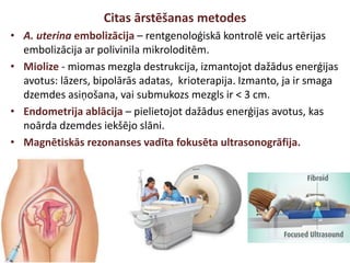 Citas ārstēšanas metodes
• A. uterina embolizācija – rentgenoloģiskā kontrolē veic artērijas
embolizācija ar polivinila mikroloditēm.
• Miolize - miomas mezgla destrukcija, izmantojot dažādus enerģijas
avotus: lāzers, bipolārās adatas, krioterapija. Izmanto, ja ir smaga
dzemdes asiņošana, vai submukozs mezgls ir < 3 cm.
• Endometrija ablācija – pielietojot dažādus enerģijas avotus, kas
noārda dzemdes iekšējo slāni.
• Magnētiskās rezonanses vadīta fokusēta ultrasonogrāfija.
 