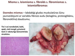 Mioma s. leiomioma s. fibroīds s. fibromiomas s.
leiomiofibromas
Dzemdes miomas – labdabīgi gludas muskulatūras šūnu
jaunveidojumi ar variablu fibrozo audu (kolagēna, proteoglikānu,
fibronektīna) daudzumu;
Tie ir asi norobežoti, balti,
apaļi, cieti mezgli, griezienā
tiem ir raksturīga koncentriska
struktūra.
 