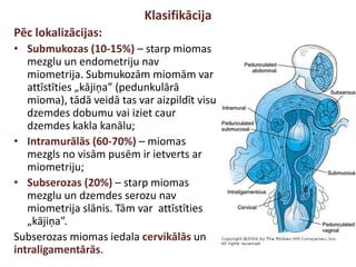 Klasifikācija
Pēc lokalizācijas:
• Submukozas (10-15%) – starp miomas
mezglu un endometriju nav
miometrija. Submukozām miomām var
attīstīties „kājiņa” (pedunkulārā
mioma), tādā veidā tas var aizpildīt visu
dzemdes dobumu vai iziet caur
dzemdes kakla kanālu;
• Intramurālās (60-70%) – miomas
mezgls no visām pusēm ir ietverts ar
miometriju;
• Subserozas (20%) – starp miomas
mezglu un dzemdes serozu nav
miometrija slānis. Tām var attīstīties
„kājiņa”.
Subserozas miomas iedala cervikālās un
intraligamentārās.
 