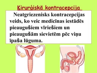Ķirurģiskā kontracepcija
Neatgriezenisks kontracepcijas
veids, ko veic medicīnas iestādēs
pieaugušiem vīriešiem un
pieaugušām sievietēm pēc viņu
īpaša lūguma.

 
