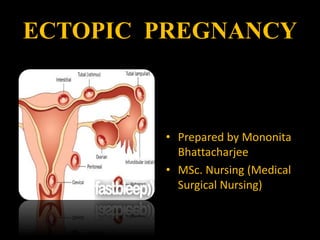 ECTOPIC PREGNANCY
• Prepared by Mononita
Bhattacharjee
• MSc. Nursing (Medical
Surgical Nursing)
 