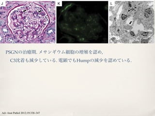 GURE 1. Histologic patterns in poststreptococcal glomerulonephritis (PSGN). A–C, The most common pattern is diffuse proliferati
 h abundant neutrophils, referred to as “exudative” glomerulonephritis (A, HE, Â400). The C3 staining on Immunofluorescen
      PSGNの治癒期. メサンギウム細胞の増殖を認め,
croscopy (IF) is prominent with a characteristic starry-sky pattern (B, Â 400), which corresponds to mesangial deposits and su
 thelial ( ) “humps” on electron microscopy (C, Â 4000). D–F, Diffuse proliferative PSGN can be lymphocyte and monocyte ri
       C3沈着も減少している. 電顕でもHumpの減少を認めている.
 h only rare neutrophils (D, Â400). The C3 deposits along the capillary wall are focally confluent (12-2’o clock) resembling a garla
pattern (E, Â 400). On EM, subepithelial humps (not shown), mesangial (arrowhead) and subendothelial deposits ( ) are seen
10,000). G, Tubulointerstitial features of acute PSGN include red blood cell casts and interstitial neutrophils ( ) (HE, Â 200). H, Le
quently, biopsies performed early or late in the course of PSGN show focal and segmental glomerular proliferation ( ) (PAS, Â40
Cellular crescents ( ) are infrequent but crescentic PSGN is well documented (JMS, Â 400). J–L, Resolving PSGN with residu
esangial proliferation ( ) (J, PAS, Â400). The C3 staining is seen on IF, albeit less intense (K, Â400). Ultrastructurally, the deposits a
 mesangium (arrowhead) along with a rare subepithelial hump ( ) (L, Â3000).

 ections cause GN despite having detectable CIC and                    of prior streptococcal infections. So, other host factors a
ere is no correlation between the amount of CIC and                    pathogen characteristics seem to determine the pred
verity of GN.24 Normal patients also have CIC, indicative              position and severity of glomerular disease.

40 | www.anatomicpathology.com                                                                 r   2012 Lippincott Williams  Wilki


  Adv Anat Pathol 2012;19:338–347
 