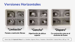 Versiones Horizontales
Romero-Apis, DA. Exploración Motora. En su: Estrabismo: Aspectos Clínicos y Tratamiento. Editorial DALA. Ciudad de México, 2010, pp. 71-101.
“Gancho”
Hiperfunción de oblicuo
superior
“Disparo”
Co-contracción como en el
síndrome de Duane
“Limitación”
Paresia o restricción fibrosa
 