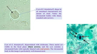 Cyst of E. histolytica/E. dispar in
an unstained concentrated wet
mount of stool. Notice the
chromatoid bodies with blunt,
rounded ends (arrow).
Cyst of E. histolytica/E. disparstained with trichrome. Three nuclei are
visible in the focal plane (black arrows), and the cyst contains a
chromatoid body with typically blunted ends (red arrow). The chromatoid
body in this image is particularly well demonstrated.
 