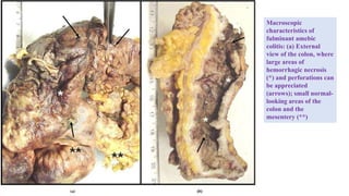 Macroscopic
characteristics of
fulminant amebic
colitis: (a) External
view of the colon, where
large areas of
hemorrhagic necrosis
(*) and perforations can
be appreciated
(arrows); small normal-
looking areas of the
colon and the
mesentery (**)
 