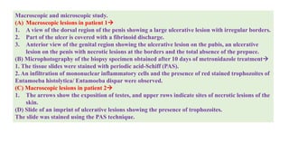 Macroscopic and microscopic study.
(A) Macroscopic lesions in patient 1
1. A view of the dorsal region of the penis showing a large ulcerative lesion with irregular borders.
2. Part of the ulcer is covered with a fibrinoid discharge.
3. Anterior view of the genital region showing the ulcerative lesion on the pubis, an ulcerative
lesion on the penis with necrotic lesions at the borders and the total absence of the prepuce.
(B) Microphotography of the biopsy specimen obtained after 10 days of metronidazole treatment
1. The tissue slides were stained with periodic acid-Schiff (PAS).
2. An infiltration of mononuclear inflammatory cells and the presence of red stained trophozoites of
Entamoeba histolytica/ Entamoeba dispar were observed.
(C) Macroscopic lesions in patient 2
1. The arrows show the exposition of testes, and upper rows indicate sites of necrotic lesions of the
skin.
(D) Slide of an imprint of ulcerative lesions showing the presence of trophozoites.
The slide was stained using the PAS technique.
 