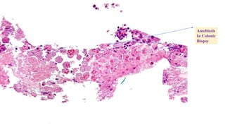Amebiasis
In Colonic
Biopsy
 
