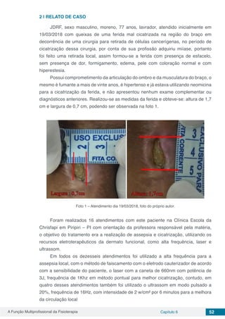 A Função Multiprofissional da Fisioterapia Capítulo 6 52
2 | 	RELATO DE CASO
JDRF, sexo masculino, moreno, 77 anos, lavrador, atendido inicialmente em
19/03/2018 com queixas de uma ferida mal cicatrizada na região do braço em
decorrência de uma cirurgia para retirada de células cancerígenas, no período de
cicatrização dessa cirurgia, por conta de sua profissão adquiriu miíase, portanto
foi feito uma retirada local, assim formou-se a ferida com presença de esfacelo,
sem presença de dor, formigamento, edema, pele com coloração normal e com
hiperestesia.
Possui comprometimento da articulação do ombro e da musculatura do braço, o
mesmo é fumante a mais de vinte anos, é hipertenso e já estava utilizando neomicina
para a cicatrização da ferida, e não apresentou nenhum exame complementar ou
diagnósticos anteriores. Realizou-se as medidas da ferida e obteve-se: altura de 1,7
cm e largura de 0,7 cm, podendo ser observada na foto 1.
Foto 1 – Atendimento dia 19/03/2018, foto do próprio autor.
Foram realizados 16 atendimentos com este paciente na Clínica Escola da
Chrisfapi em Piripiri – PI com orientação da professora responsável pela matéria,
o objetivo do tratamento era a realização de assepsia e cicatrização, utilizando os
recursos eletroterapêuticos da dermato funcional, como alta frequência, laser e
ultrassom.
Em todos os dezesseis atendimentos foi utilizado a alta frequência para a
assepsia local, com o método de faiscamento com o eletrodo cauterizador de acordo
com a sensibilidade do paciente, o laser com a caneta de 660nm com potência de
3J, frequência de 1Khz em método pontual para melhor cicatrização, contudo, em
quatro desses atendimentos também foi utilizado o ultrassom em modo pulsado a
20%, frequência de 16Hz, com intensidade de 2 w/cm² por 6 minutos para a melhora
da circulação local
 