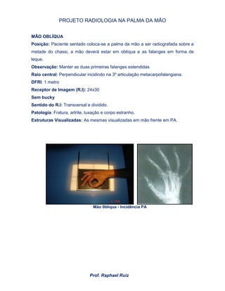 PROJETO RADIOLOGIA NA PALMA DA MÃO
Prof. Raphael Ruiz
MÃO OBLÍQUA
Posição: Paciente sentado coloca-se a palma da mão a ser radiografada sobre a
metade do chassi, a mão deverá estar em oblíqua e as falanges em forma de
leque.
Observação: Manter as duas primeiras falanges estendidas
Raio central: Perpendicular incidindo na 3º articulação metacarpofalangiana.
DFRI: 1 metro
Receptor de Imagem (R.I): 24x30
Sem bucky
Sentido do R.I: Transversal e dividido.
Patologia: Fratura, artrite, luxação e corpo estranho.
Estruturas Visualizadas: As mesmas visualizadas em mão frente em PA.
Mão 0bliqua - Incidência PA
 