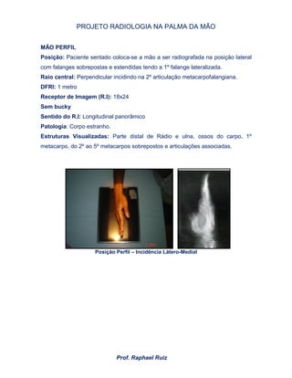 PROJETO RADIOLOGIA NA PALMA DA MÃO
Prof. Raphael Ruiz
MÃO PERFIL
Posição: Paciente sentado coloca-se a mão a ser radiografada na posição lateral
com falanges sobrepostas e estendidas tendo a 1º falange lateralizada.
Raio central: Perpendicular incidindo na 2º articulação metacarpofalangiana.
DFRI: 1 metro
Receptor de Imagem (R.I): 18x24
Sem bucky
Sentido do R.I: Longitudinal panorâmico
Patologia: Corpo estranho.
Estruturas Visualizadas: Parte distal de Rádio e ulna, ossos do carpo, 1º
metacarpo, do 2º ao 5º metacarpos sobrepostos e articulações associadas.
Posição Perfil – Incidência Látero-Medial
 