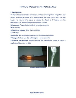 PROJETO RADIOLOGIA NA PALMA DA MÃO
Prof. Raphael Ruiz
PUNHO PERFIL
Posição: Paciente sentado, coloca-se o punho a ser radiografado em perfil, o qual
sofrerá uma rotação lateral de 5º externamente, de modo que o rádio e a ulna
fiquem na mesma linha, sobre a metade do chassi, a 1º falange em PA
lateralizada e as demais falanges sobrepostos e unidos.
Raio central: Perpendicular incidindo no centro do punho.
DFRI: 1 metro
Receptor de Imagem (R.I): 13x18 ou 18x24
Sem bucky
Sentido do R.I: Longitudinal panorâmico / Transversal e dividido.
Patologia: Fratura, luxação, calcificações e corpo estranho.
Estruturas Visualizadas: Região proximal dos metacarpos, ossos do carpo e
região distal da ulna e do rádio.
Incidência látero-medial
 