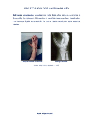 PROJETO RADIOLOGIA NA PALMA DA MÃO
Prof. Raphael Ruiz
Estruturas visualizadas: Visualizam-se rádio distal, ulna, carpo e, ao menos, a
área média do metacarpo. O trapézio e o escafóide devem ser bem visualizados,
com somente ligeira superposição de outros ossos carpais em seus aspectos
mediais.
Obliqua interna ou medial Obliqua medial
Fonte: BONTRAGER, Kenneth L., 2003
 