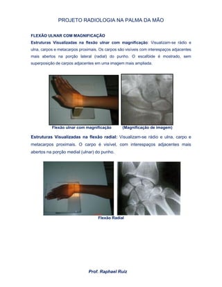 PROJETO RADIOLOGIA NA PALMA DA MÃO
Prof. Raphael Ruiz
FLEXÃO ULNAR COM MAGNIFICAÇÃO
Estruturas Visualizadas na flexão ulnar com magnificação: Visualizam-se rádio e
ulna, carpos e metacarpos proximais. Os carpos são visíveis com interespaços adjacentes
mais abertos na porção lateral (radial) do punho. O escafóide é mostrado, sem
superposição de carpos adjacentes em uma imagem mais ampliada.
Flexão ulnar com magnificação (Magnificação de imagem)
Estruturas Visualizadas na flexão radial: Visualizam-se rádio e ulna, carpo e
metacarpos proximais. O carpo é visível, com interespaços adjacentes mais
abertos na porção medial (ulnar) do punho.
Flexão Radial
 