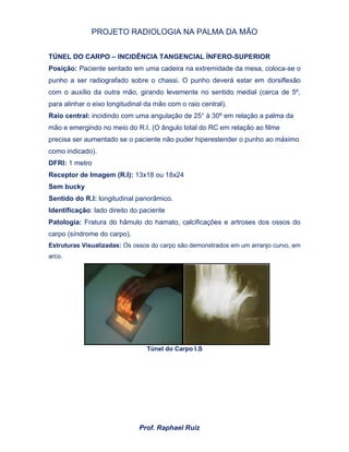 PROJETO RADIOLOGIA NA PALMA DA MÃO
Prof. Raphael Ruiz
TÚNEL DO CARPO – INCIDÊNCIA TANGENCIAL ÍNFERO-SUPERIOR
Posição: Paciente sentado em uma cadeira na extremidade da mesa, coloca-se o
punho a ser radiografado sobre o chassi. O punho deverá estar em dorsiflexão
com o auxílio da outra mão, girando levemente no sentido medial (cerca de 5º,
para alinhar o eixo longitudinal da mão com o raio central).
Raio central: incidindo com uma angulação de 25° à 30º em relação a palma da
mão e emergindo no meio do R.I. (O ângulo total do RC em relação ao filme
precisa ser aumentado se o paciente não puder hiperestender o punho ao máximo
como indicado).
DFRI: 1 metro
Receptor de Imagem (R.I): 13x18 ou 18x24
Sem bucky
Sentido do R.I: longitudinal panorâmico.
Identificação: lado direito do paciente
Patologia: Fratura do hâmulo do hamato, calcificações e artroses dos ossos do
carpo (síndrome do carpo).
Estruturas Visualizadas: Os ossos do carpo são demonstrados em um arranjo curvo, em
arco.
Túnel do Carpo I.S
 
