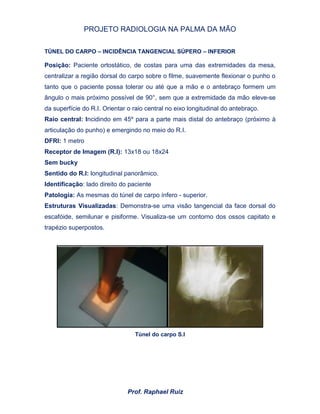 PROJETO RADIOLOGIA NA PALMA DA MÃO
Prof. Raphael Ruiz
TÚNEL DO CARPO – INCIDÊNCIA TANGENCIAL SÚPERO – INFERIOR
Posição: Paciente ortostático, de costas para uma das extremidades da mesa,
centralizar a região dorsal do carpo sobre o filme, suavemente flexionar o punho o
tanto que o paciente possa tolerar ou até que a mão e o antebraço formem um
ângulo o mais próximo possível de 90°, sem que a extremidade da mão eleve-se
da superfície do R.I. Orientar o raio central no eixo longitudinal do antebraço.
Raio central: Incidindo em 45º para a parte mais distal do antebraço (próximo à
articulação do punho) e emergindo no meio do R.I.
DFRI: 1 metro
Receptor de Imagem (R.I): 13x18 ou 18x24
Sem bucky
Sentido do R.I: longitudinal panorâmico.
Identificação: lado direito do paciente
Patologia: As mesmas do túnel de carpo ínfero - superior.
Estruturas Visualizadas: Demonstra-se uma visão tangencial da face dorsal do
escafóide, semilunar e pisiforme. Visualiza-se um contorno dos ossos capitato e
trapézio superpostos.
Túnel do carpo S.I
 