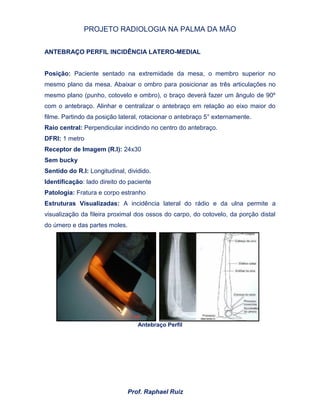 PROJETO RADIOLOGIA NA PALMA DA MÃO
Prof. Raphael Ruiz
ANTEBRAÇO PERFIL INCIDÊNCIA LATERO-MEDIAL
Posição: Paciente sentado na extremidade da mesa, o membro superior no
mesmo plano da mesa. Abaixar o ombro para posicionar as três articulações no
mesmo plano (punho, cotovelo e ombro), o braço deverá fazer um ângulo de 90º
com o antebraço. Alinhar e centralizar o antebraço em relação ao eixo maior do
filme. Partindo da posição lateral, rotacionar o antebraço 5° externamente.
Raio central: Perpendicular incidindo no centro do antebraço.
DFRI: 1 metro
Receptor de Imagem (R.I): 24x30
Sem bucky
Sentido do R.I: Longitudinal, dividido.
Identificação: lado direito do paciente
Patologia: Fratura e corpo estranho
Estruturas Visualizadas: A incidência lateral do rádio e da ulna permite a
visualização da fileira proximal dos ossos do carpo, do cotovelo, da porção distal
do úmero e das partes moles.
Antebraço Perfil
 
