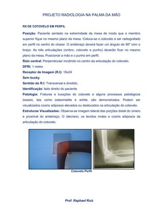PROJETO RADIOLOGIA NA PALMA DA MÃO
Prof. Raphael Ruiz
RX DE COTOVELO EM PERFIL
Posição: Paciente sentado na extremidade da mesa de modo que o membro
superior fique no mesmo plano da mesa. Coloca-se o cotovelo a ser radiografado
em perfil no centro do chassi. O antebraço deverá fazer um ângulo de 90º com o
braço. As três articulações (ombro, cotovelo e punho) deverão ficar no mesmo
plano da mesa. Posicionar a mão e o punho em perfil.
Raio central: Perpendicular incidindo no centro da articulação do cotovelo.
DFRI: 1 metro
Receptor de Imagem (R.I): 18x24
Sem bucky
Sentido do R.I: Transversal e dividido.
Identificação: lado direito do paciente
Patologia: Fraturas e luxações do cotovelo e alguns processos patológicos
ósseos, tais como osteomielite e artrite, são demonstrados. Podem ser
visualizados coxins adiposos elevados ou deslocados na articulação do cotovelo.
Estruturas Visualizadas: Observa-se imagem lateral das porções distal do úmero
e proximal do antebraço. O olecrano, os tecidos moles e coxins adiposos da
articulação do cotovelo.
Cotovelo Perfil
 