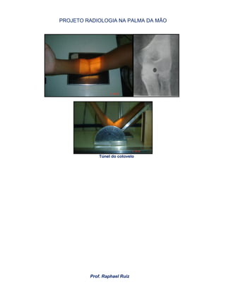 PROJETO RADIOLOGIA NA PALMA DA MÃO
Prof. Raphael Ruiz
Túnel do cotovelo
 