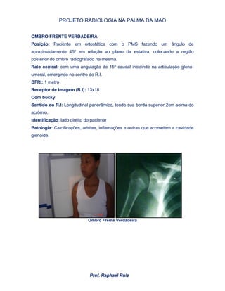 PROJETO RADIOLOGIA NA PALMA DA MÃO
Prof. Raphael Ruiz
OMBRO FRENTE VERDADEIRA
Posição: Paciente em ortostática com o PMS fazendo um ângulo de
aproximadamente 45º em relação ao plano da estativa, colocando a região
posterior do ombro radiografado na mesma.
Raio central: com uma angulação de 15º caudal incidindo na articulação gleno-
umeral, emergindo no centro do R.I.
DFRI: 1 metro
Receptor de Imagem (R.I): 13x18
Com bucky
Sentido do R.I: Longitudinal panorâmico, tendo sua borda superior 2cm acima do
acrômio.
Identificação: lado direito do paciente
Patologia: Calcificações, artrites, inflamações e outras que acometem a cavidade
glenóide.
Ombro Frente Verdadeira
 
