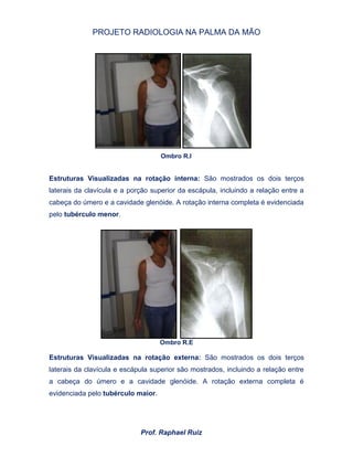 PROJETO RADIOLOGIA NA PALMA DA MÃO
Prof. Raphael Ruiz
Ombro R.I
Estruturas Visualizadas na rotação interna: São mostrados os dois terços
laterais da clavícula e a porção superior da escápula, incluindo a relação entre a
cabeça do úmero e a cavidade glenóide. A rotação interna completa é evidenciada
pelo tubérculo menor.
Ombro R.E
Estruturas Visualizadas na rotação externa: São mostrados os dois terços
laterais da clavícula e escápula superior são mostrados, incluindo a relação entre
a cabeça do úmero e a cavidade glenóide. A rotação externa completa é
evidenciada pelo tubérculo maior.
 