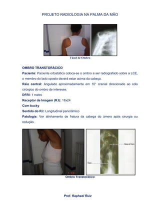 PROJETO RADIOLOGIA NA PALMA DA MÃO
Prof. Raphael Ruiz
Túnel de Ombro
OMBRO TRANSTORÁCICO
Paciente: Paciente ortostático coloca-se o ombro a ser radiografado sobre a LCE,
o membro do lado oposto deverá estar acima da cabeça.
Raio central: Angulado aproximadamente em 10° cranial direcionado ao colo
cirúrgico do ombro de interesse.
DFRI: 1 metro
Receptor de Imagem (R.I): 18x24
Com bucky
Sentido do R.I: Longitudinal panorâmico
Patologia: Ver alinhamento de fratura da cabeça do úmero após cirurgia ou
redução.
Ombro Transtorácico
 