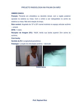 PROJETO RADIOLOGIA NA PALMA DA MÃO
Prof. Raphael Ruiz
OMBRO ZANCA
Posição: Paciente em ortostática ou decúbito dorsal, com a região posterior
apoiada na estativa ou mesa. Com o ombro a ser radiografado no centro da
estativa ou mesa. Não terá rotação do braço.
Raio central: Angulado de 15º à 20º cranial incidindo no espaço articular acrômio
– umeral.
DFRI: 1 metro
Receptor de Imagem (R.I): 18x24, tendo sua borda superior 2cm acima do
acrômio.
Com bucky
Sentido do R.I: Longitudinal panorâmico
Patologia: Luxação de articulação acrômio – clavicular.
Ombro Zanca
 