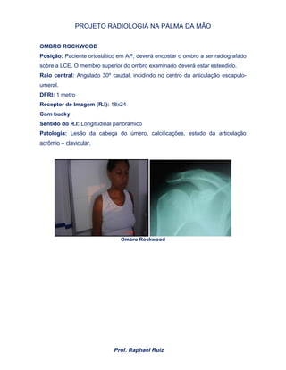 PROJETO RADIOLOGIA NA PALMA DA MÃO
Prof. Raphael Ruiz
OMBRO ROCKWOOD
Posição: Paciente ortostático em AP, deverá encostar o ombro a ser radiografado
sobre a LCE. O membro superior do ombro examinado deverá estar estendido.
Raio central: Angulado 30º caudal, incidindo no centro da articulação escapulo-
umeral.
DFRI: 1 metro
Receptor de Imagem (R.I): 18x24
Com bucky
Sentido do R.I: Longitudinal panorâmico
Patologia: Lesão da cabeça do úmero, calcificações, estudo da articulação
acrômio – clavicular.
Ombro Rockwood
 