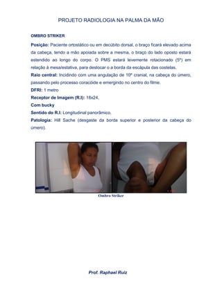 PROJETO RADIOLOGIA NA PALMA DA MÃO
Prof. Raphael Ruiz
OMBRO STRIKER
Posição: Paciente ortostático ou em decúbito dorsal, o braço ficará elevado acima
da cabeça, tendo a mão apoiada sobre a mesma, o braço do lado oposto estará
estendido ao longo do corpo. O PMS estará levemente rotacionado (5º) em
relação á mesa/estativa, para deslocar o a borda da escápula das costelas.
Raio central: Incidindo com uma angulação de 10º cranial, na cabeça do úmero,
passando pelo processo coracóide e emergindo no centro do filme.
DFRI: 1 metro
Receptor de Imagem (R.I): 18x24,
Com bucky
Sentido do R.I: Longitudinal panorâmico.
Patologia: Hill Sache (desgaste da borda superior e posterior da cabeça do
úmero).
Ombro Striker
 