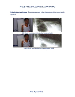 PROJETO RADIOLOGIA NA PALMA DA MÃO
Prof. Raphael Ruiz
Estruturas visualizadas: Corpo da clavícula, extremidade acromial e extremidade
esternal.
Clavícula Frente com raio central perpendicular
Clavícula AP com raio central angulado cranial
 