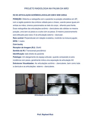 PROJETO RADIOLOGIA NA PALMA DA MÃO
Prof. Raphael Ruiz
RX DE ARTICULAÇÃO ACRÔMIOCLAVICULAR COM E SEM CARGA
POSIÇÃO: Obtenha a radiografia com o paciente na posição ortostática em AP,
com a região posterior dos ombros voltada para o chassi, usando pesos iguais em
ambas as mãos, úmeros posicionados ao lado do corpo; olhando para frente.
Duas radiografias das articulações acrômio - claviculares são obtidas na mesma
posição, uma sem os pesos e a outra com os pesos. O mesmo posicionamento
será efetuado para raios–X da articulação esterno - clavicular.
Raio central: Perpendicular em relação à estativa, incidindo na incisura jugular.
DFRI: 1 metro
Com bucky
Receptor de Imagem (R.I): 30x40
Sentido do R.I: Transversal panorâmico
Identificação: lado direito do paciente
Patologia: Um alargamento do espaço articular, quando comparado à outra
incidência com pesos, geralmente indica uma separação da articulação AC
Estruturas Visualizadas: As articulações acrômio - claviculares, bem como toda
a clavícula e as articulações esterno - claviculares.
Articulação acromioclavicular
 