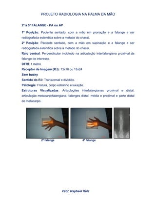 PROJETO RADIOLOGIA NA PALMA DA MÃO
Prof. Raphael Ruiz
2º a 5º FALANGE - PA ou AP
1º Posição: Paciente sentado, com a mão em pronação e a falange a ser
radiografada estendida sobre a metade do chassi.
2º Posição: Paciente sentado, com a mão em supinação e a falange a ser
radiografada estendida sobre a metade do chassi.
Raio central: Perpendicular incidindo na articulação interfalangiana proximal da
falange de interesse.
DFRI: 1 metro
Receptor de Imagem (R.I): 13x18 ou 18x24
Sem bucky
Sentido do R.I: Transversal e dividido.
Patologia: Fratura, corpo estranho e luxação.
Estruturas Visualizadas: Articulações interfalangianas proximal e distal,
articulação metacarpofalangiana, falanges distal, média e proximal e parte distal
do metacarpo.
2º falange 4º falange
 
