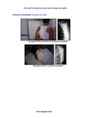 PROJETO RADIOLOGIA NA PALMA DA MÃO
Prof. Raphael Ruiz
Estrutura Visualizada: Escápula em perfil
Escápula Perfil p/ acrômio ou processo coracóide
Escápula Perfil p/ o corpo da escapula
 