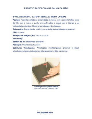 PROJETO RADIOLOGIA NA PALMA DA MÃO
Prof. Raphael Ruiz
2º FALANGE PERFIL - LÁTERO- MEDIAL ou MÉDIO- LATERAL
Posição: Paciente sentado na extremidade da mesa, com o cotovelo fletido cerca
de 90º, com a mão e o punho em perfil sobre o chassi com a falange a ser
radiografada estendida. Flexionar as falanges não afetadas.
Raio central: Perpendicular incidindo na articulação interfalangiana proximal.
DFRI: 1 metro
Receptor de Imagem (R.I): 13x18 ou 18x24
Sem bucky
Sentido do R.I: Transversal e dividido.
Patologia: Fraturas e/ou luxações
Estruturas Visualizadas: Articulações interfalangianas proximal e distal,
articulação metacarpofalangiana e falanges distal, média e proximal.
2º falange Perfil (médio-lateral)
Fonte: BONTRAGER, Kenneth L., 2003
 