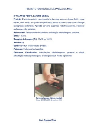 PROJETO RADIOLOGIA NA PALMA DA MÃO
Prof. Raphael Ruiz
3º FALANGE PERFIL LÁTERO-MEDIAL
Posição: Paciente sentado na extremidade da mesa, com o cotovelo fletido cerca
de 90º, com a mão e o punho em perfil repousando sobre o chassi com a falange
radiografada estendida. Apoiada por uma superfície radiotransparente. Flexionar
as falanges não afetadas.
Raio central: Perpendicular incidindo na articulação interfalangiana proximal.
DFRI: 1 metro
Receptor de Imagem (R.I): 13x18 ou 18x24
Sem bucky
Sentido do R.I: Transversal e dividido.
Patologia: Fraturas e/ou luxações.
Estruturas Visualizadas: Articulações interfalangianas proximal e distal,
articulação metacarpofalangiana e falanges distal, média e proximal.
Terceira falange (látero-medial)
Fonte: BONTRAGER, Kenneth L., 2003
 