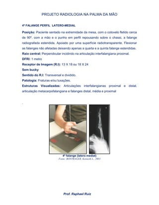 PROJETO RADIOLOGIA NA PALMA DA MÃO
Prof. Raphael Ruiz
4º FALANGE PERFIL LATERO-MEDIAL
Posição: Paciente sentado na extremidade da mesa, com o cotovelo fletido cerca
de 90º, com a mão e o punho em perfil repousando sobre o chassi, a falange
radiografada estendida. Apoiado por uma superfície radiotransparente. Flexionar
as falanges não afetadas deixando apenas a quarta e a quinta falange estendidas.
Raio central: Perpendicular incidindo na articulação interfalangiana proximal.
DFRI: 1 metro
Receptor de Imagem (R.I): 13 X 18 ou 18 X 24
Sem bucky
Sentido do R.I: Transversal e dividido.
Patologia: Fraturas e/ou luxações.
Estruturas Visualizadas: Articulações interfalangianas proximal e distal,
articulação metacarpofalangiana e falanges distal, média e proximal
.
4º falange (latero medial)
Fonte: BONTRAGER, Kenneth L., 2003
 